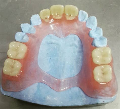 dental technician on Instagram: “Thermosens denture #dentist #dentistry ...