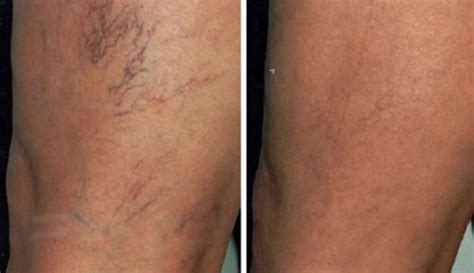 Laser Vein Treatment – DermaHealth