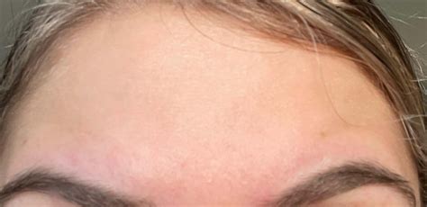 Neurotoxin Treatment 2 - Seattle Beauty
