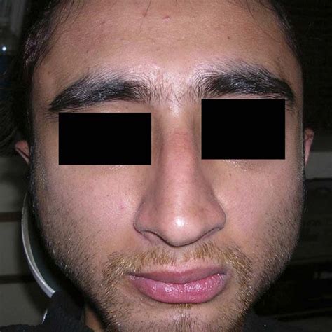 patient showing partial improvement  facial nerve function   years