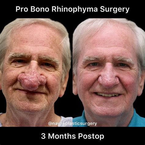 Before & After Rhinophyma Reduction Procedures in St. Louis MO | Nayak