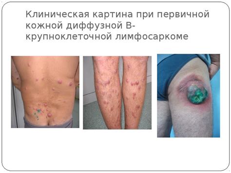 Лимфомы кожи