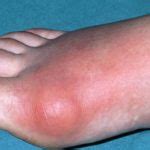 Gout - Daramola Medical Clinic