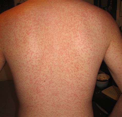Rash On Skin After Exercise: 4 Easy Tips To Prevent & Treat