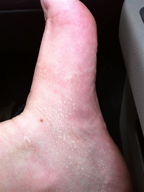 Hyperhidrosis and Summer - My Life as a Puddle