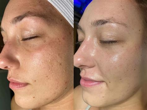 HydraFacial Before and After: Real Photos & Simple Steps