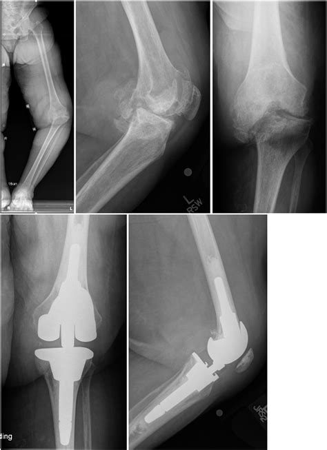 Complex Primary Total Knee Arthroplasty: Long-Term Outcomes : JBJS