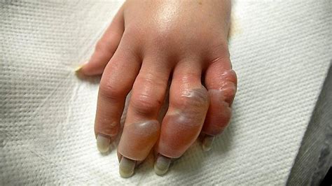 Frostbite