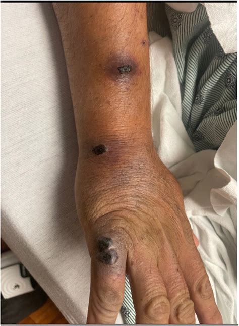 Leukemia cutis mimicking a sporotrichoid distribution as initial