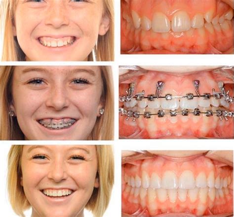 Mini Implante Ortodontico Antes E Depois