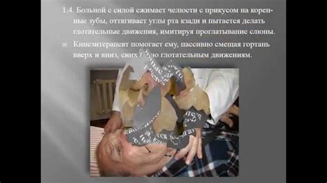 Бульбарный синдром - YouTube