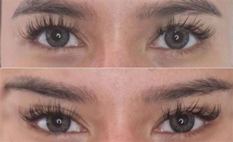 fox eye thread lift  complete guide diaminyaesthetics