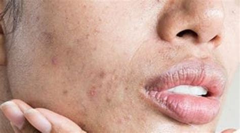 Espinha Na Lateral Do Rosto - Mapa da acne: significado das espinhas em cada área do rosto