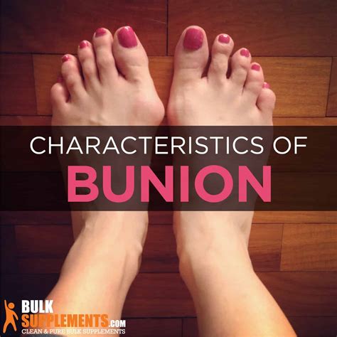 Hallux Valgus (Bunions): Causes, Characteristics & Treatment