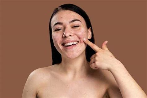 Как избавиться от подкожных прыщей на лице быстро