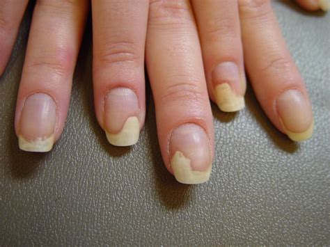 Onicolisis | Nail diseases and disorders, Nail disorders, Dermatitis ...