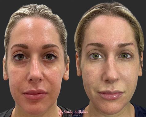 Cheek Fillers - Before & After Results at Skinly