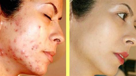 rid  orange peel   face  larry yockey blog