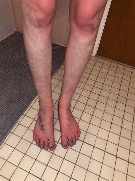 Is this a POTS symptom or something bigger?! These are my legs/feet