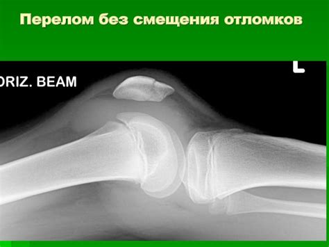 Повреждения коленного сустава - презентация онлайн