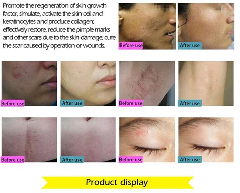 Face Care Acne Scar Removal Cream Acne Spots Skin Care Treatment ...