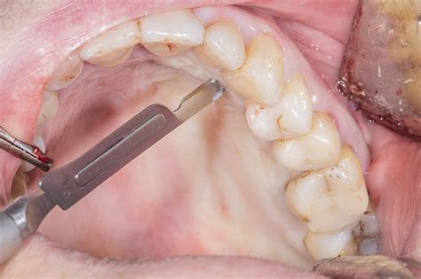 Dental Bone Graft Success Rate at Stanley Blake blog