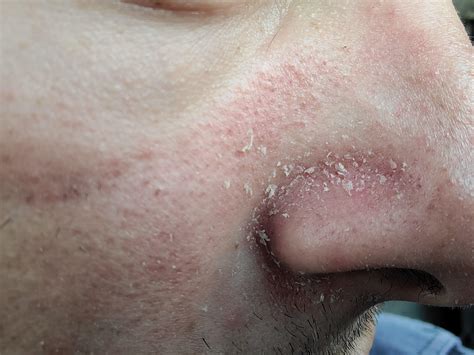 dry skin face red 10