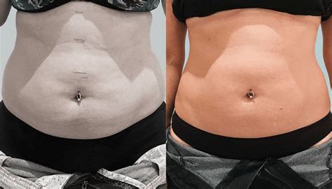 Ultracavitação Antes E Depois - Ultracavitação - Salvador | Clínicas Nepuga