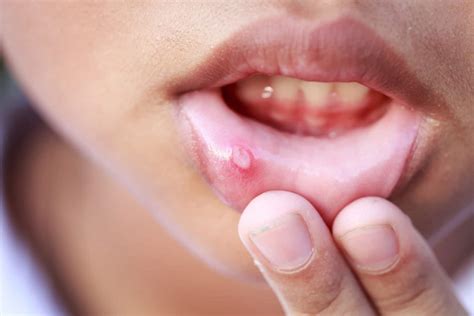 Афти и Язви в Устата | Impression Dent