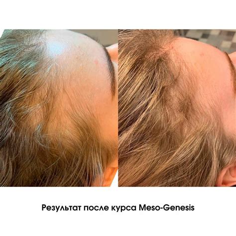 Мезотерапия для волос отзывы