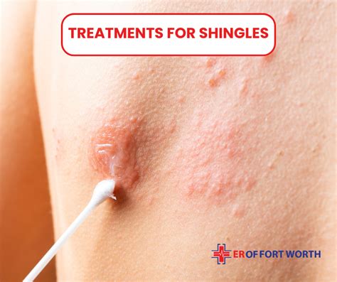 shingles      signs  treatment