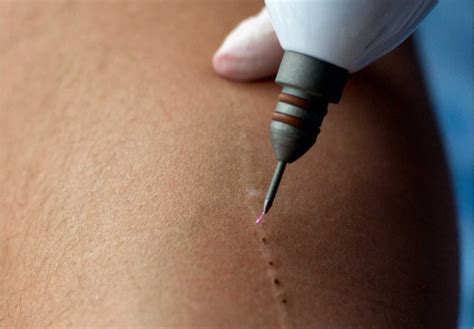 O Que É Jato De Plasma - Jato de Plasma: O que é, Como Funciona e Benefícios na Estética - IBRAMED
