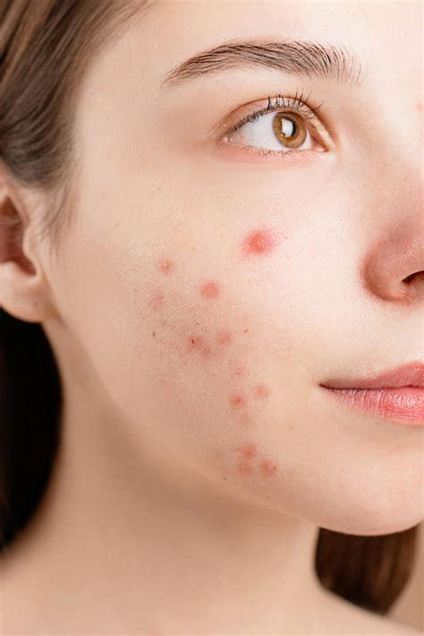 Understanding Closed Comedones: Causes and Treatments ~ The Beauty Stations
