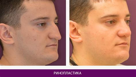 Ринопластика, ціна на пластику носа в Києві | LaserOne