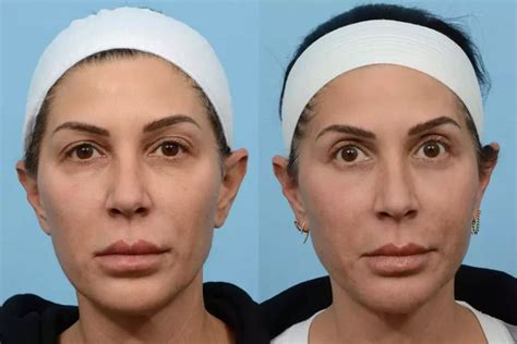 levisa lazer: Before & After Photos That Will Amaze You - ozy6t06