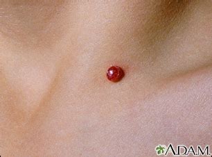 Granuloma piógeno