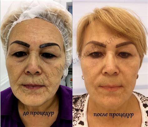 Лазерная Шлифовка Лица Со2 Фото До И После - HD фотoграфии
