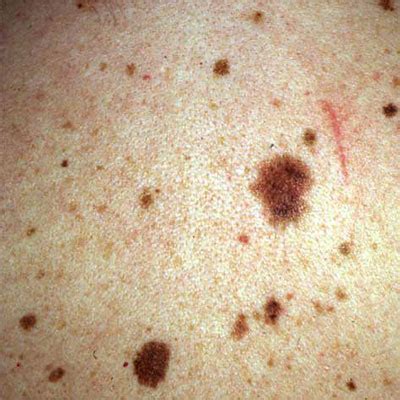 dysplastic nevus atypical mole dkbvx