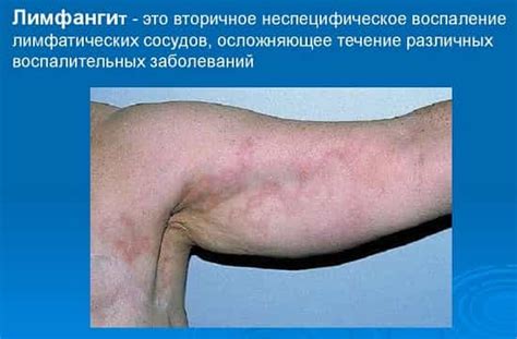 Как проявляется лимфангит? Лечение и профилактика болезни