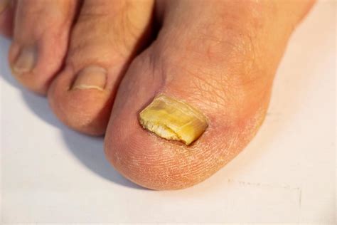 commettere Percentuale bordo micosi unghie piedi smalto Validazione ...