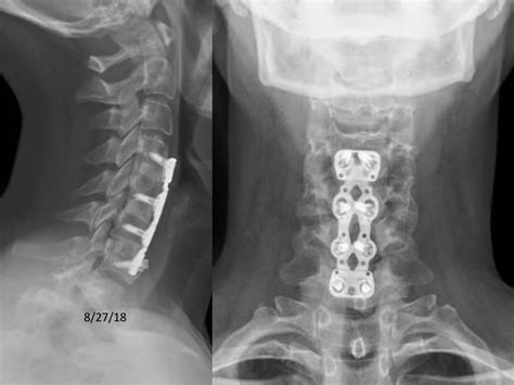 lecture spine acdf nonunion repair