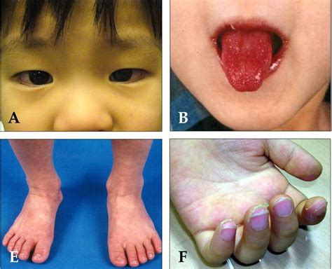 kawasaki disease diagnostic criteria geeky medics