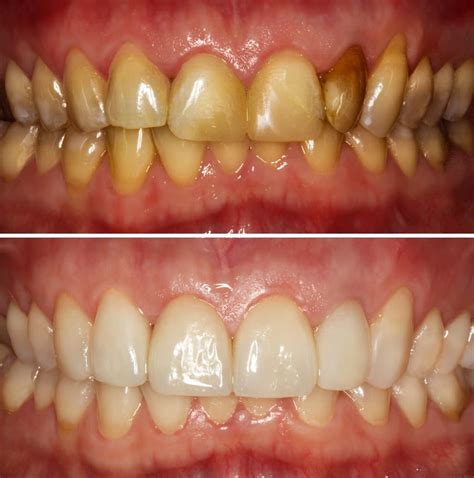 Causes of yellow teeth and how to get rid of it | ILAJAK Medical