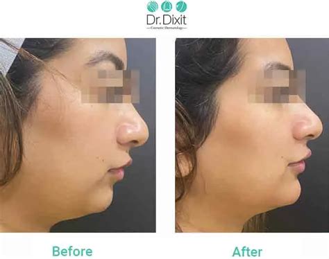 Chin Augmentation Results