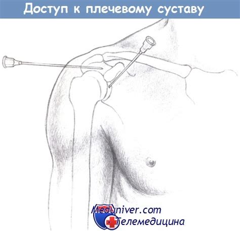 Точки и техника пункции суставов