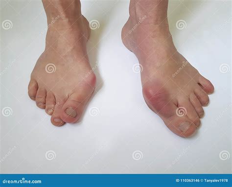 Valgus Deformity Of Legs Royalty-Free Stock Image | CartoonDealer.com ...