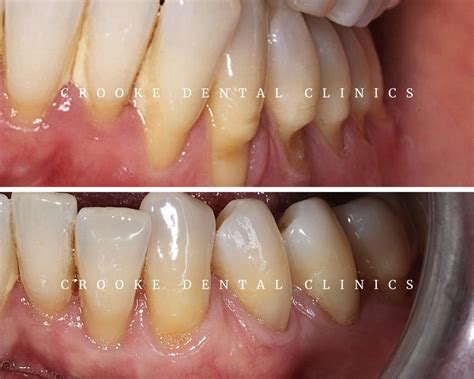 Gingival Graft Before And After