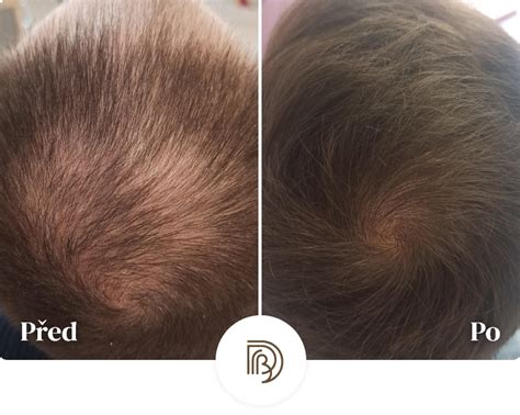 Moji pacienti - Dr. Brabcová - léčba alopecie a vypadávání vlasů