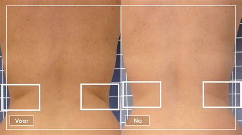 Icoone® behandeling - Smooth Laser Clinic