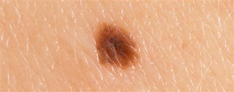Skin Lesions